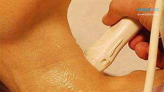 Triplex καρωτίδων: μια πολύτιμη εξέταση