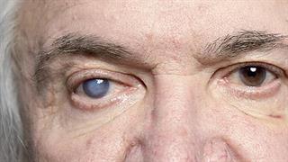 Εκπαίδευση του κοινού για τον καταρράκτη