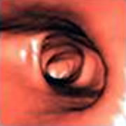 Εικόνα 4. Εικονική κολονοσκόπηση