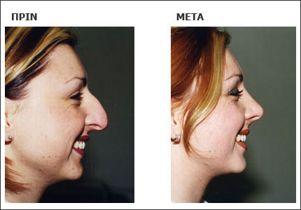 Η τεχνική της ρινοπλαστικής σήμερα είναι τόσο προχωρημένη, ώστε να μπορεί κανείς να τη συνιστά σε όποιον το επιθυμεί με βεβαιότητα, χωρίς καμία αμφιβολία και προβληματισμό.