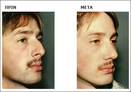 Μετά την εγχείρηση ρινοπλαστικής, η ίαση είναι γρήγορη, λόγω της αυξημένης αιμάτωσης της κεφαλής.