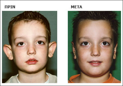 Με τον σχηματισμό της ανθέλικος χειρουργικά, παύει πλέον το πτερύγιο να αφίσταται (να πετά) της κεφαλής και το αυτί παίρνει την κανονική του θέση ως προς το κεφάλι.