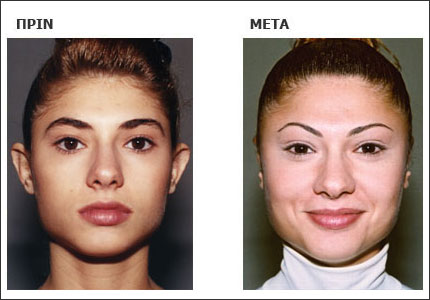 Το αισθητικό αποτέλεσμα της ωτοπλαστικής παραμένει για όλη τη ζωή αναλλοίωτο και τα αυτιά δεν αλλάζουν ποτέ πια θέση, αρκεί η εγχείρηση να έχει γίνει από έμπειρο ειδικό πλαστικό χειρουργό, ο οποίος θα εφαρμόσει όλους τους κανόνες της ενδεδειγμένης χειρουργικής τεχνικής.