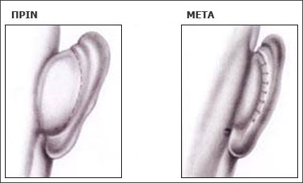 Υπάρχουν πολλές χειρουργικές τεχνικές, οι οποίες εφαρμόζονται ανάλογα με τη δυσμορφία των αυτιών, το πάχος του χόνδρου και το μέγεθος της κόγχης του πτερυγίου. Όλες αποσκοπούν στο καλύτερο μετεγχειρητικό αισθητικό αποτέλεσμα.