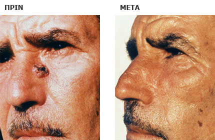 Αφαίρεση επιθηλιώματος προσώπου και πλαστική αποκατάσταση του ελλείμματος με γειτονικό δερματικό κρημνό