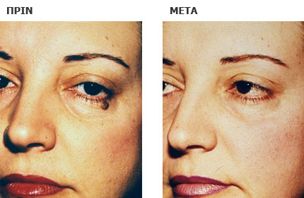 Αφαίρεση μικρού σπίλου και πλαστική αποκατάσταση με απλή συρραφή